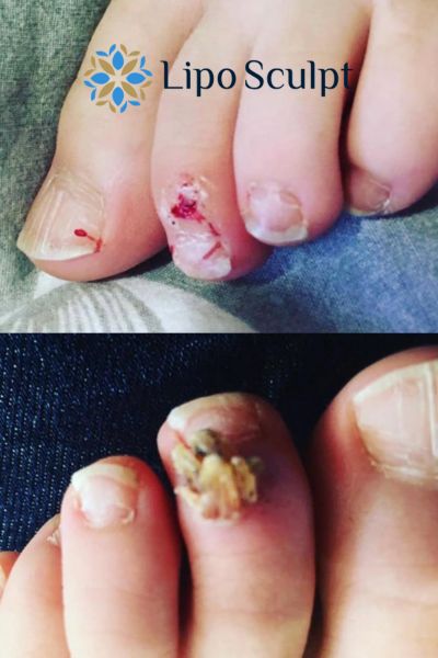 Wart removal customer results from Lipo Sculpt Earl Shilton